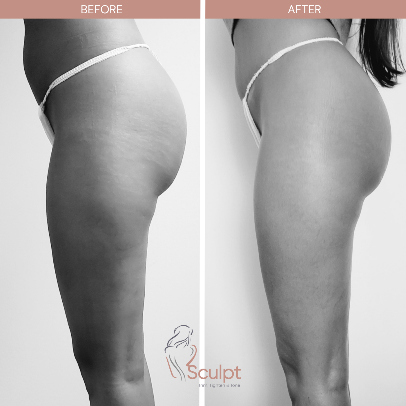 Before and After - Legs